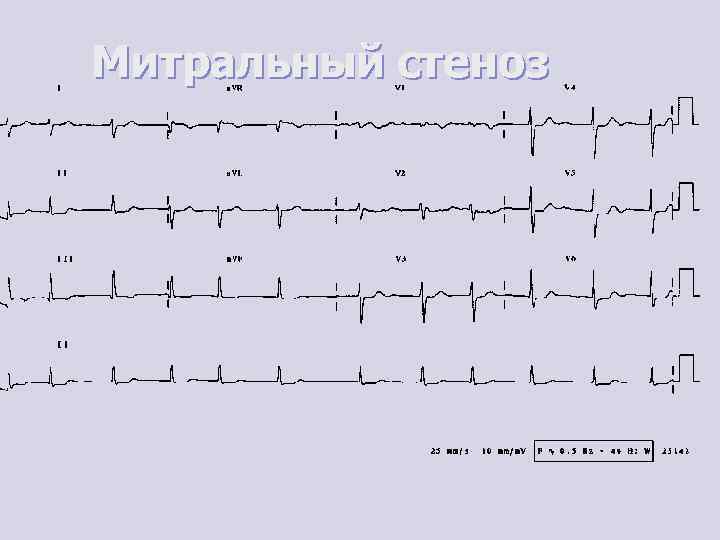 Митральный стеноз 