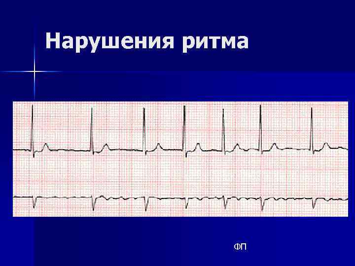 Нарушения ритма ФП 