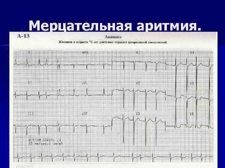 Мерцательная аритмия. 