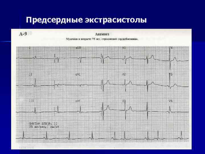 Предсердные экстрасистолы 