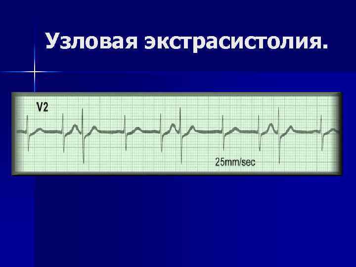 Узловая экстрасистолия. 