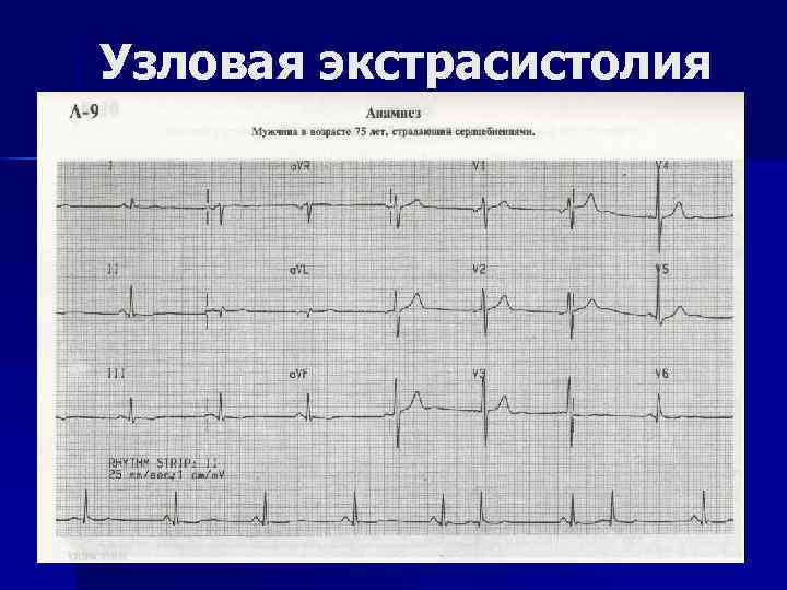 Узловая экстрасистолия 