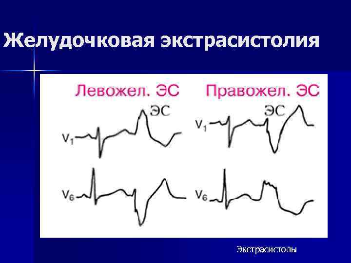 Желудочковая экстрасистолия Экстрасистолы 