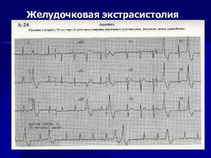 Желудочковая экстрасистолия 