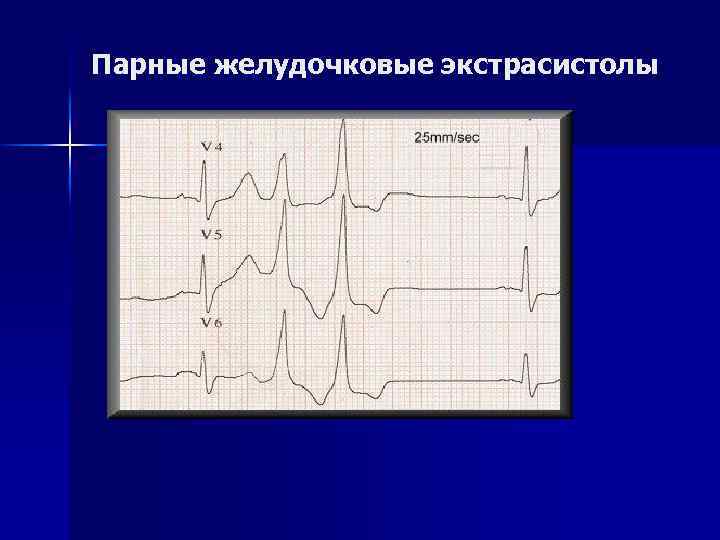 Парные желудочковые экстрасистолы 