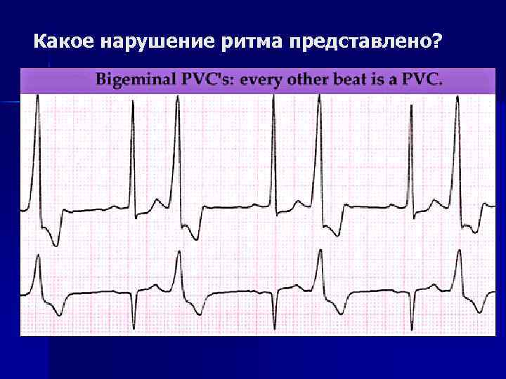 Какое нарушение ритма представлено? 