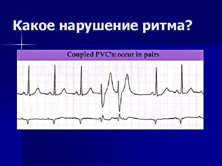 Какое нарушение ритма? 