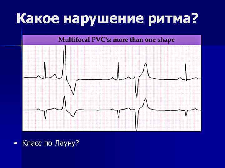 Какое нарушение ритма? • Класс по Лауну? 