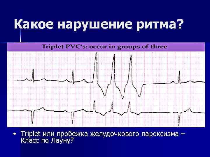 Какое нарушение ритма? • Triplet или пробежка желудочкового пароксизма – Класс по Лауну? 