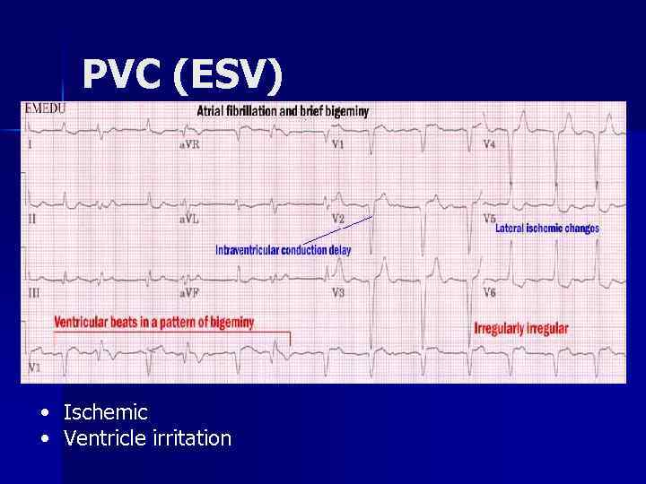 PVC (ESV) • Ischemic • Ventricle irritation 