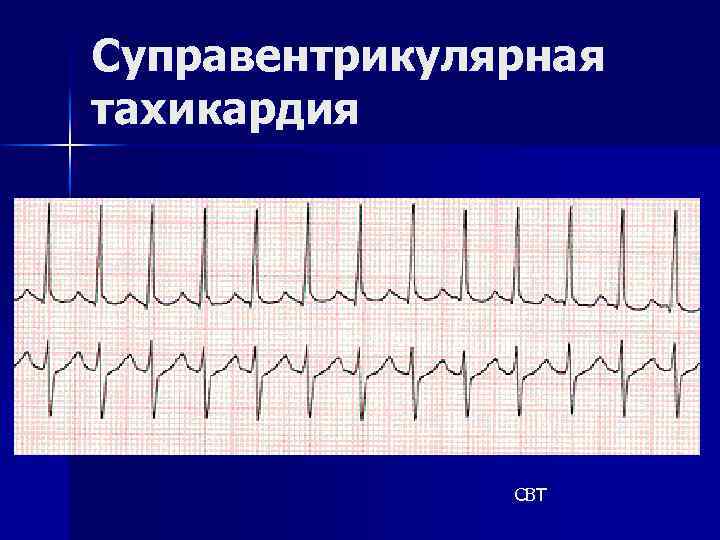 Суправентрикулярная тахикардия СВТ 