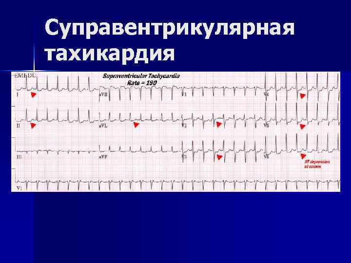 Суправентрикулярная тахикардия 
