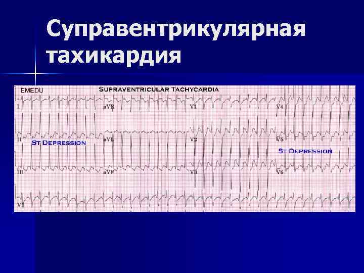 Суправентрикулярная тахикардия 
