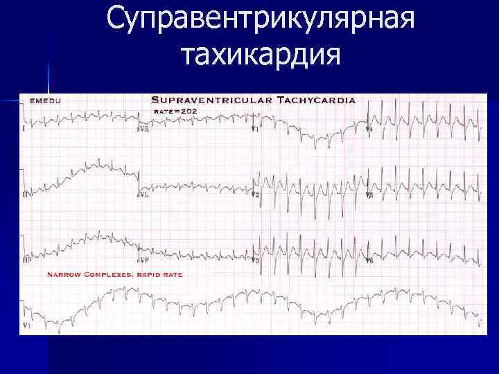 Суправентрикулярная тахикардия 
