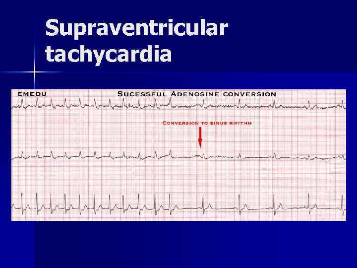 Supraventricular tachycardia 