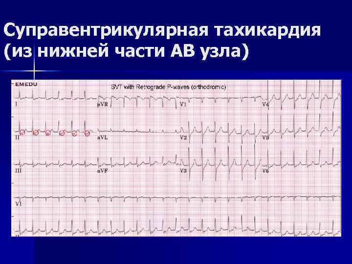 Суправентрикулярная тахикардия (из нижней части АВ узла) 