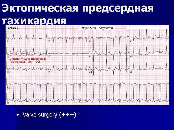 Эктопическая предсердная тахикардия • Valve surgery (+++) 