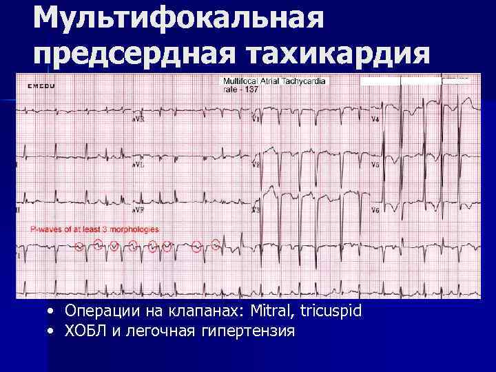 Мультифокальная предсердная тахикардия • Операции на клапанах: Mitral, tricuspid • ХОБЛ и легочная гипертензия