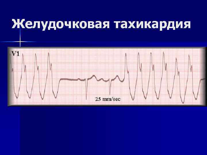 Желудочковая тахикардия 