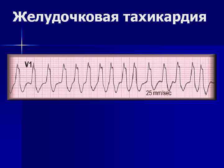 Желудочковая тахикардия 