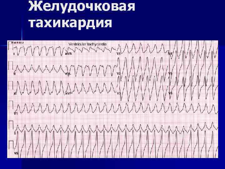 Желудочковая тахикардия 