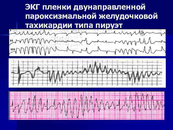 ЭКГ пленки двунаправленной пароксизмальной желудочковой тахикардии типа пируэт 