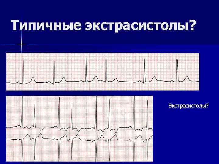 Типичные экстрасистолы? Экстрасистолы? 