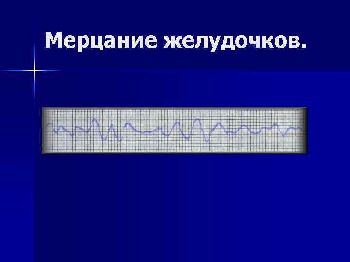 Мерцание желудочков. 