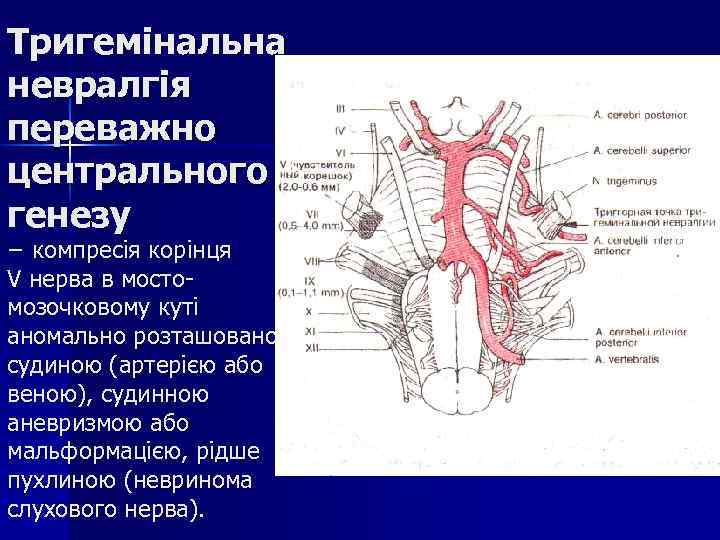 Тригемінальна невралгія переважно центрального генезу − компресія корінця V нерва в мостомозочковому куті аномально