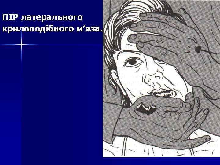 ПІР латерального крилоподібного м’яза. 