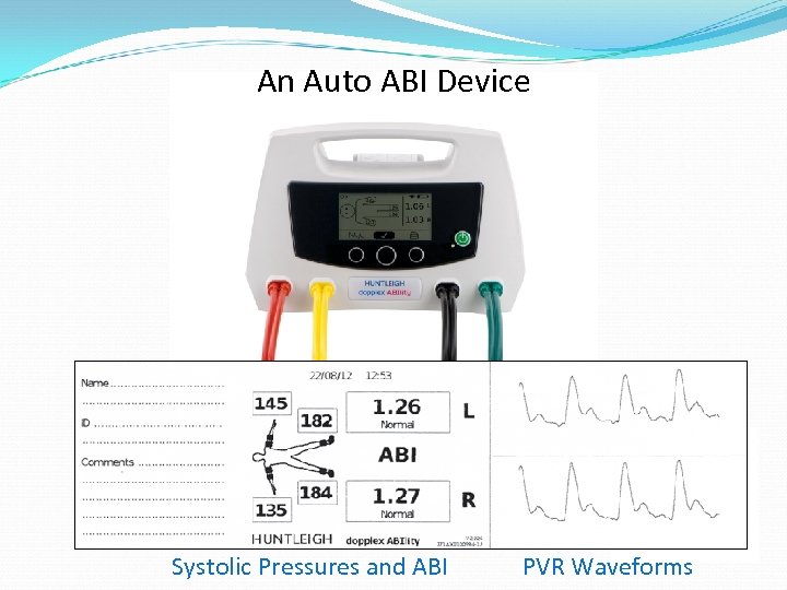 An Auto ABI Device Systolic Pressures and ABI PVR Waveforms 