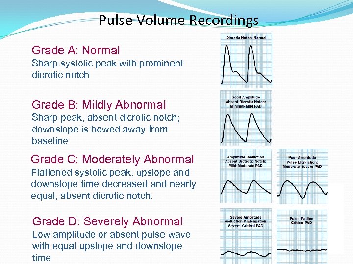 Pulse Volume Recordings Grade A: Normal Sharp systolic peak with prominent dicrotic notch Grade