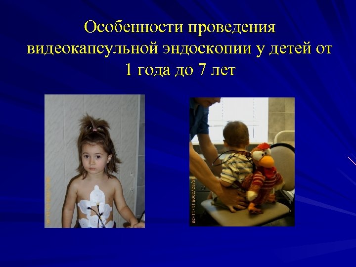 Особенности проведения видеокапсульной эндоскопии у детей от 1 года до 7 лет 