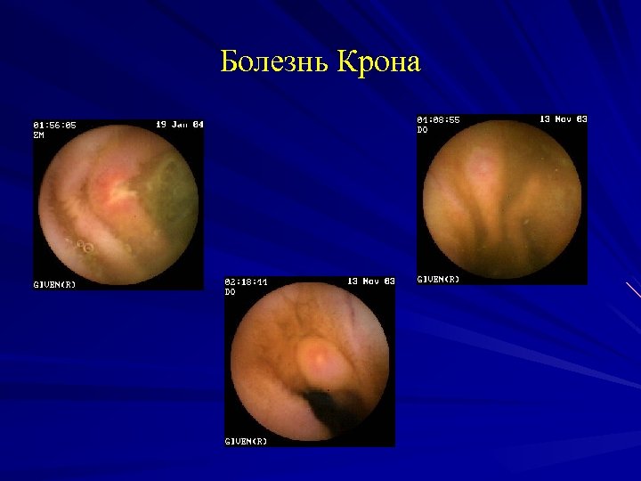 Болезнь Крона 