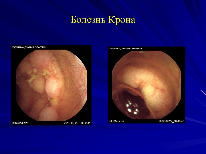 Болезнь Крона 