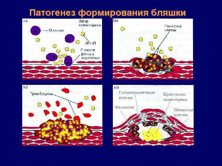 Патогенез формирования бляшки Гладкомышечные клетки Коллаген Кристаллы холестерина Пенистые клетки 