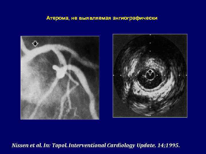 Атерома, не выявляемая ангиографически Nissen et al. In: Topol. Interventional Cardiology Update. 14; 1995.