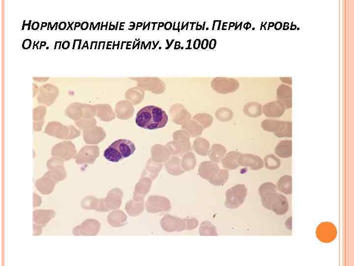 НОРМОХРОМНЫЕ ЭРИТРОЦИТЫ. ПЕРИФ. КРОВЬ. ОКР. ПО ПАППЕНГЕЙМУ. УВ. 1000 