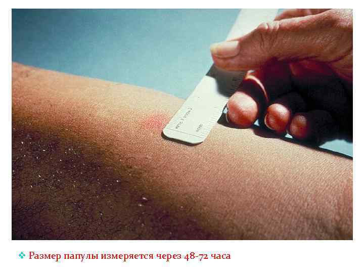 v Размер папулы измеряется через 48 -72 часа 