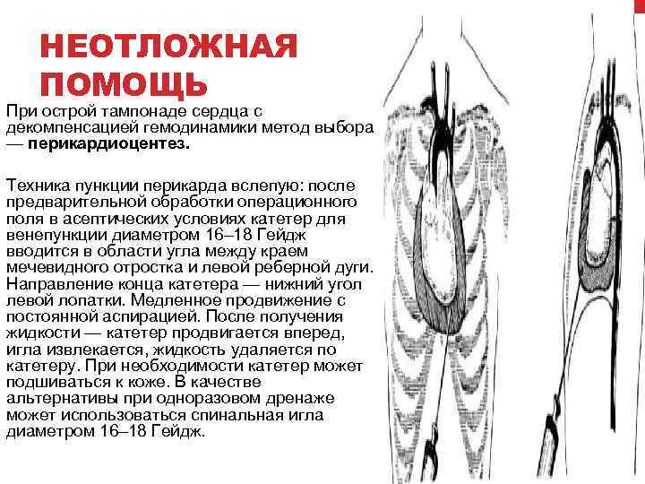 Тампонада сердца презентация