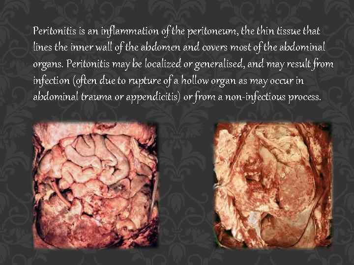 Peritonitis is an inflammation of the peritoneum, the thin tissue that lines the inner