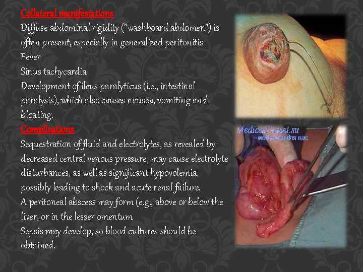 Collateral manifestations Diffuse abdominal rigidity (