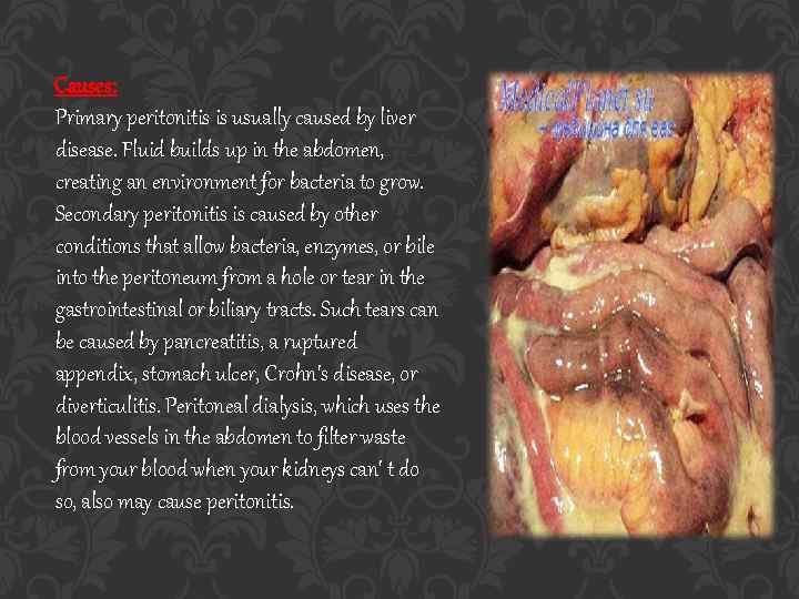 Causes: Primary peritonitis is usually caused by liver disease. Fluid builds up in the