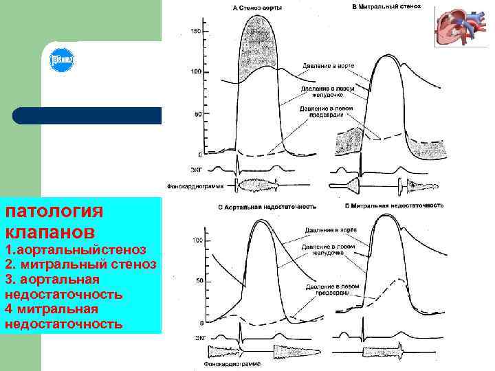 патология клапанов 1. аортальныйстеноз 2. митральный стеноз 3. аортальная недостаточность 4 митральная недостаточность 