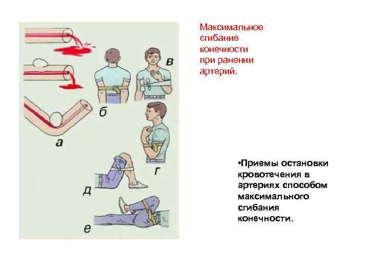 Максимальное сгибание конечности при ранении артерий. • Приемы остановки кровотечения в артериях способом максимального