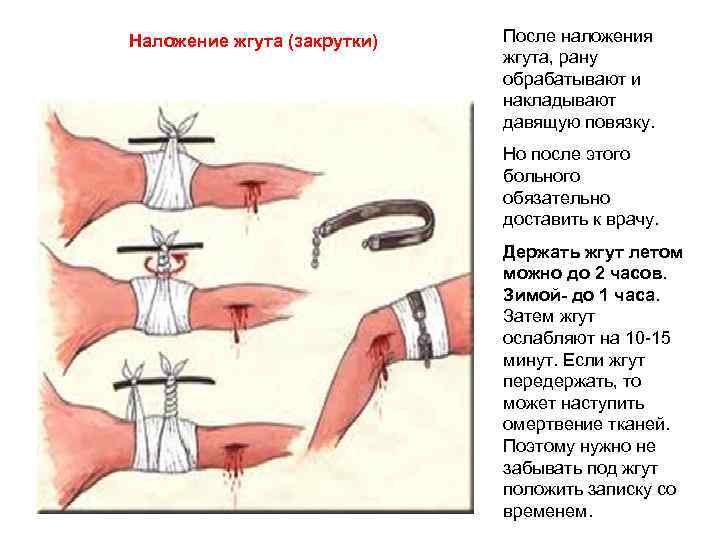 Наложение жгута (закрутки) После наложения жгута, рану обрабатывают и накладывают давящую повязку. Но после