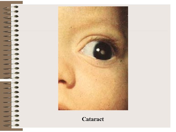 Cataract 