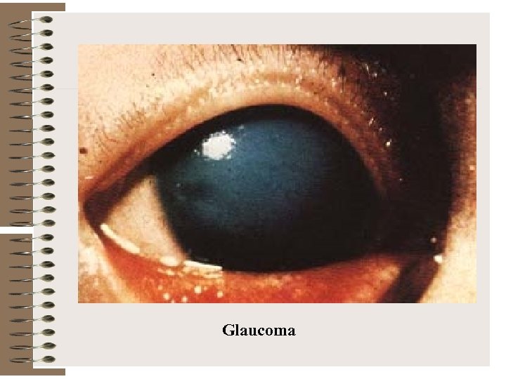 Glaucoma 