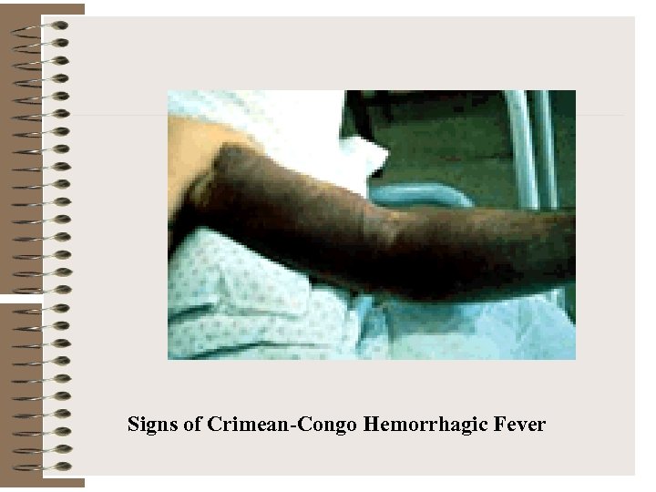 Signs of Crimean-Congo Hemorrhagic Fever 