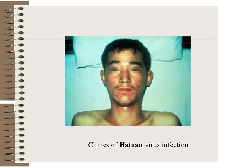 Clinics of Hataan virus infection 